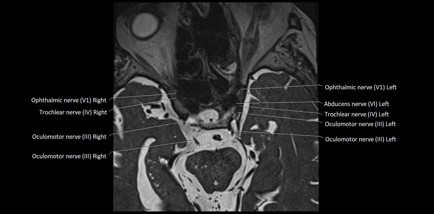 Cranial nerve anatomy axial MRI 3T image 23.webp